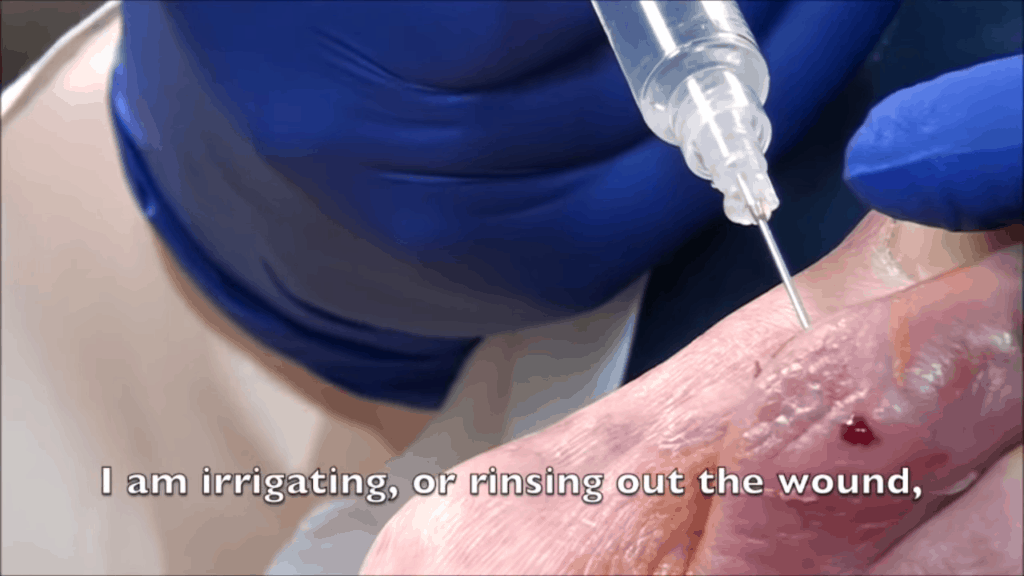 Protruding Pus from Toe 6