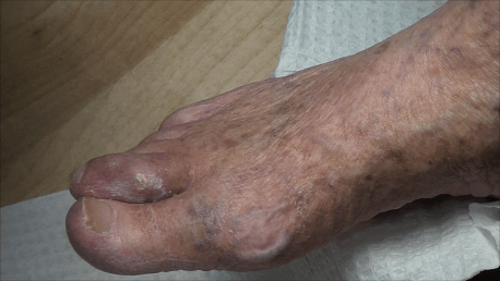 Protruding Pus from Toe 8